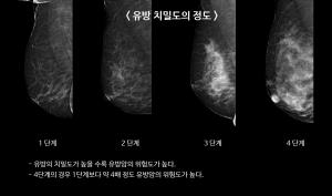 치밀 유방이 무엇인가요? < 건강칼럼 < 의학 < 기사본문 - 정신의학신문